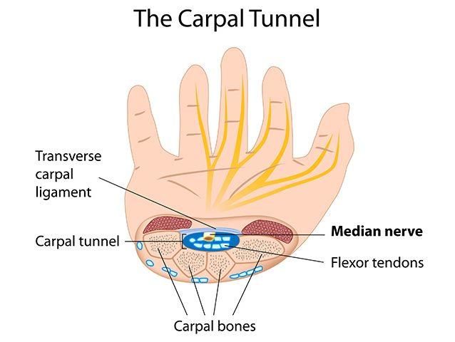 How To Deal With Carpal Tunnel Syndrome In Pregnancy?