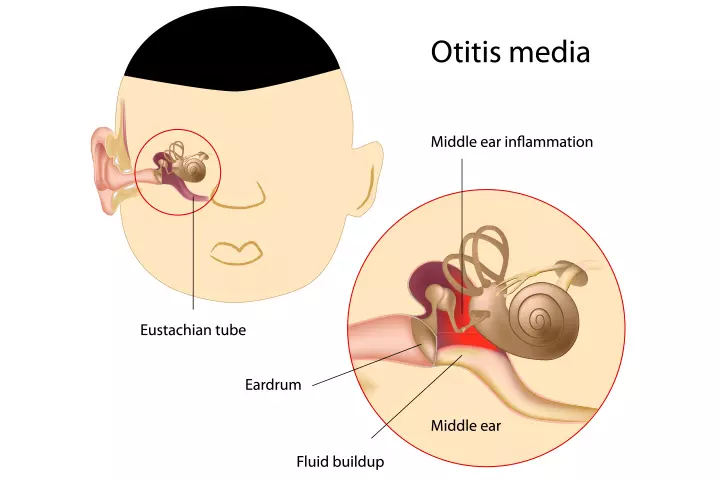 Ear infection in toddlers