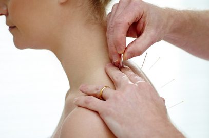 Acupuncture During Pregnancy: Is It Safe? Benefits And Risk