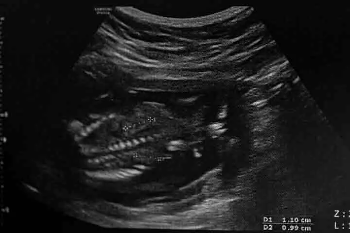 Anomaly scan is done when you're 21 weeks pregnant