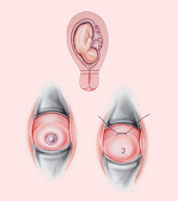 Cervix During Pregnancy: Causes, Symptoms And Treatment