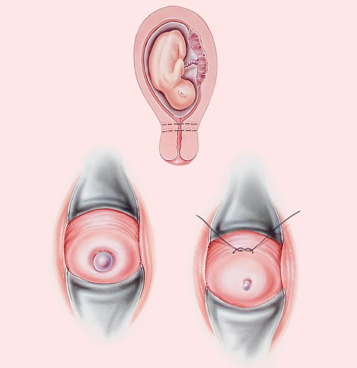 what-does-the-cervix-look-like-during-pregnancy-pregnancywalls