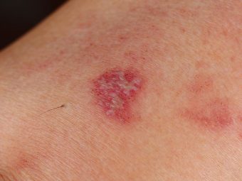 Exposure To Shingles While Pregnant: Are You At Risk And How To Avoid It?