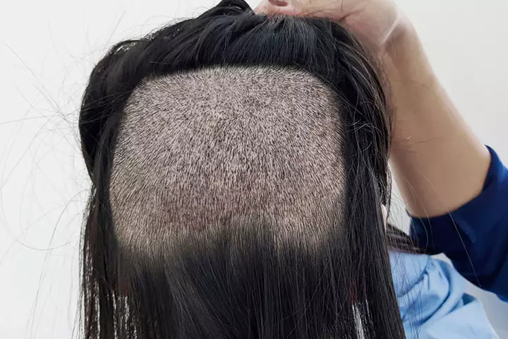 Hair transplantation can help for severe cases of hairfall
