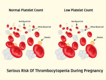 Thrombocytopenia In Pregnancy: Causes, Risks And Treatment