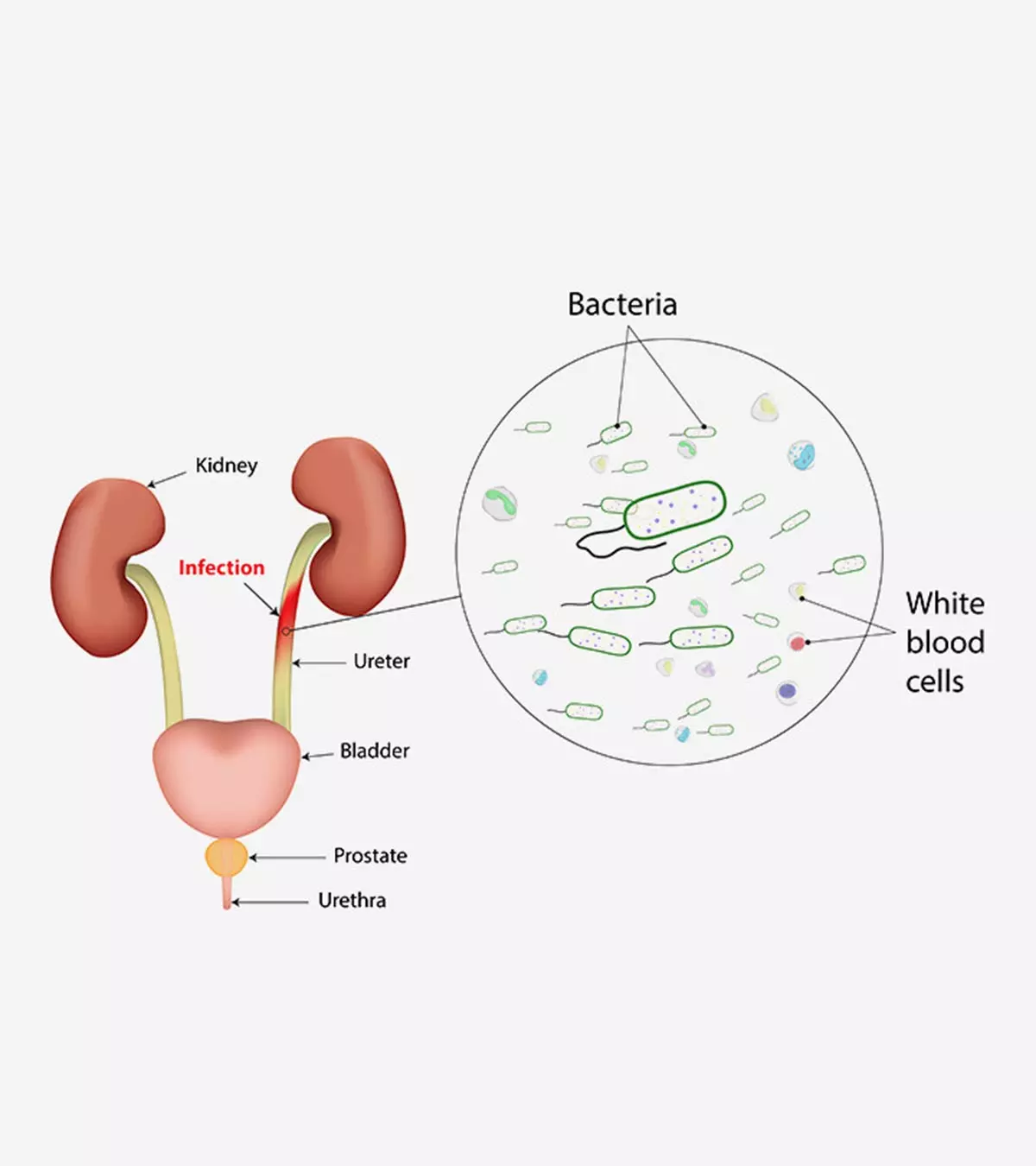 Urinary Tract Infection (UTI) In Pregnancy Symptoms & Treatment