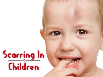 8 Ways To Treat Scars In Children And Tips For Prevention