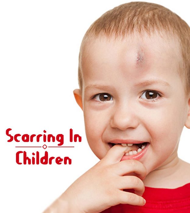 8 Ways To Treat Scars In Children And Tips For Prevention