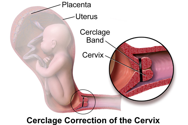 What Is Cervical Cerclage