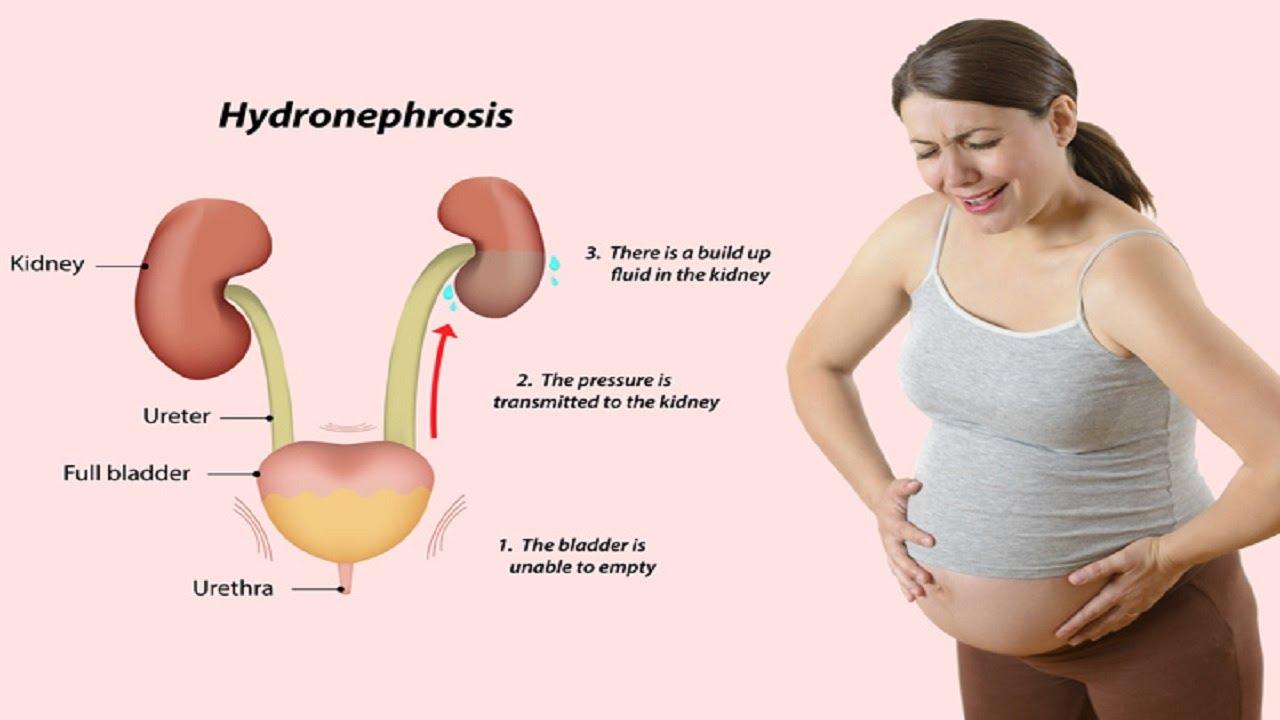 urinary-tract-infection-uti-in-pregnancy-symptoms-treatment