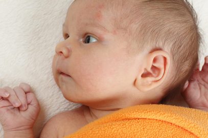 Soy Allergy In Baby: Causes, Symptoms And Treatment