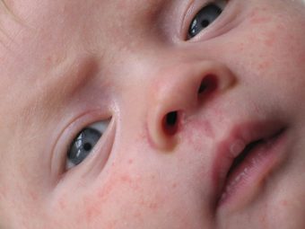 5 Types Of Skin Allergies In Babies, Treatment & Prevention