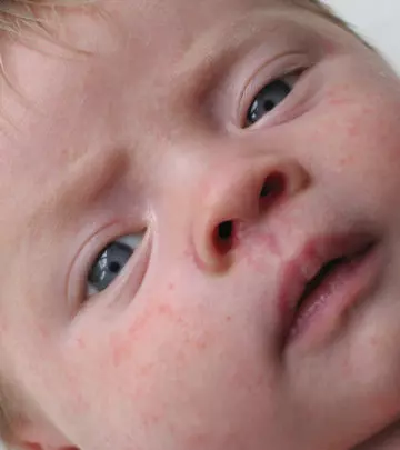 5 Common Baby Skin Allergies And Its Causes