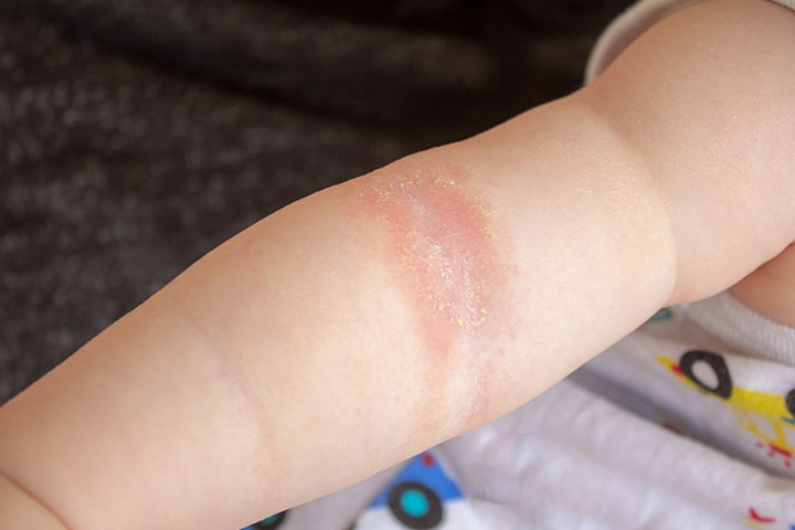 Allergic contact dermatitis, skin allergy in babies