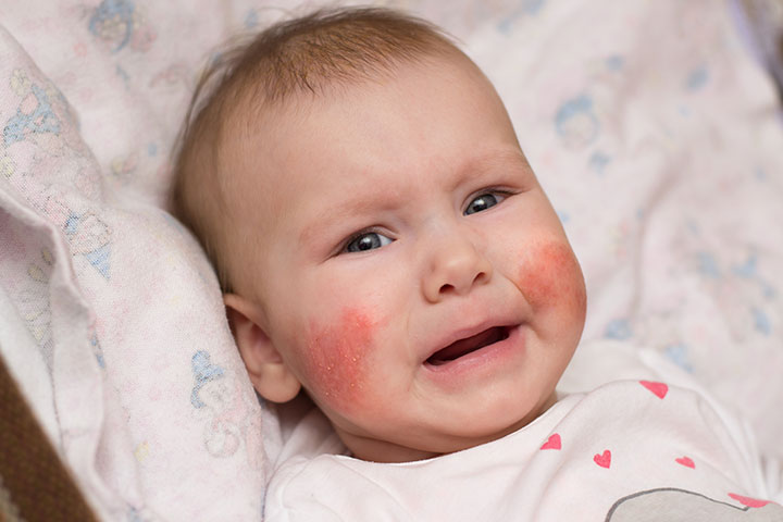 Atopic dermatitis or eczema, skin allergy in babies