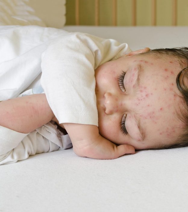 Chickenpox In Babies: Symptoms, Causes And Treatment