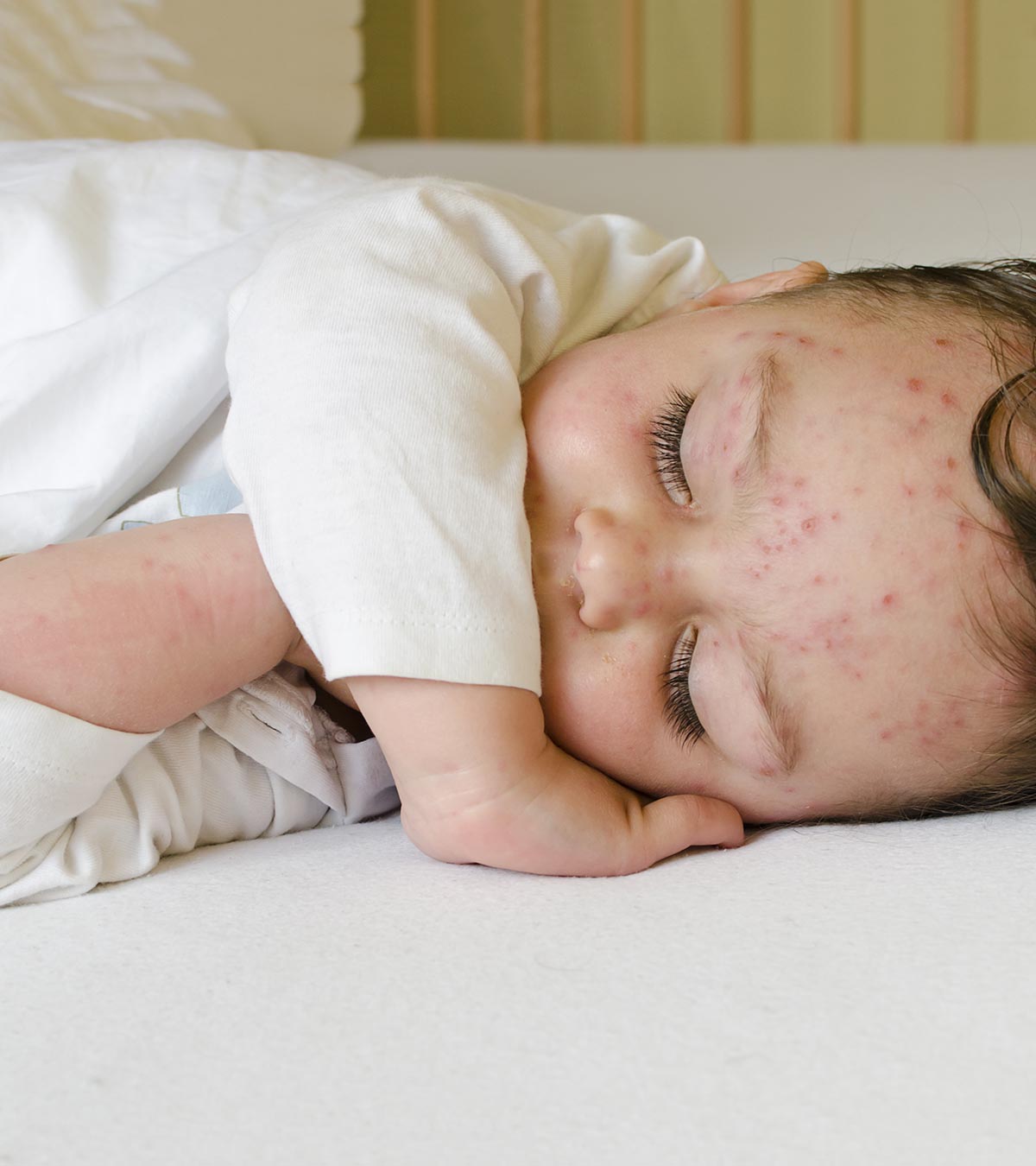 婴儿水痘:症状、原因和治疗