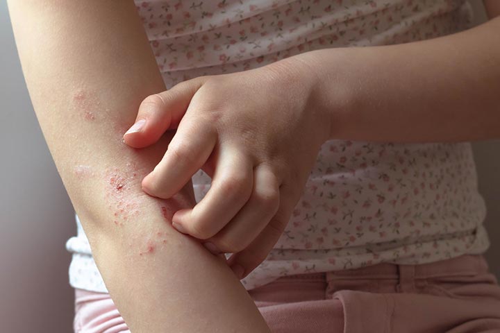 Eczema can cause dry skin in children
