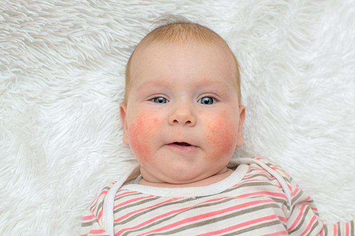 12 Symptoms Of Egg Allergy In Babies And Their Treatment