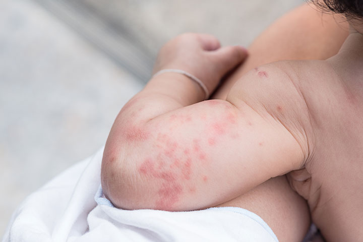 Hives, skin allergy in babies