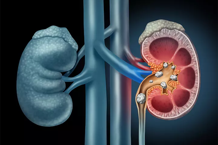 Kidney stones may be a cause of maternal hydronephrosis
