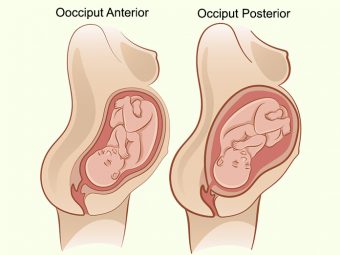Occiput Posterior: Does It Affect Labor And How To Manage It?