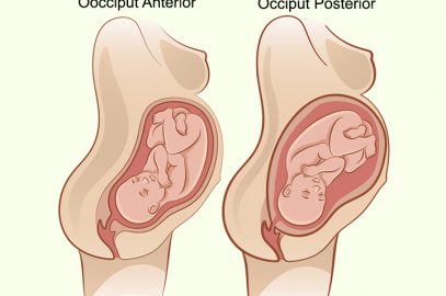 Causes Of Occiput Posterior Position And Management Tips