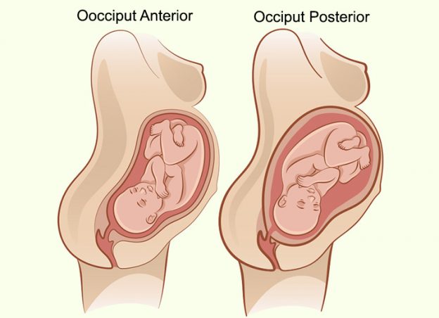 Causes Of Occiput Posterior Position And Management Tips