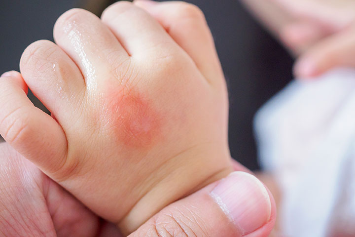 Papular Urticaria, skin allergy in babies