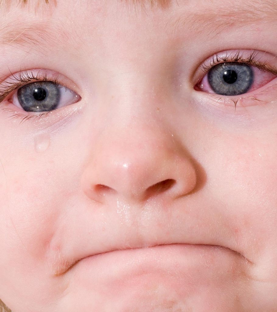 Pink Eye In Toddlers 3 Causes, 8 Symptoms & 4 Treatments