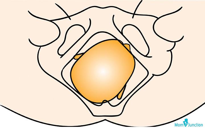 Right occiput posterior position