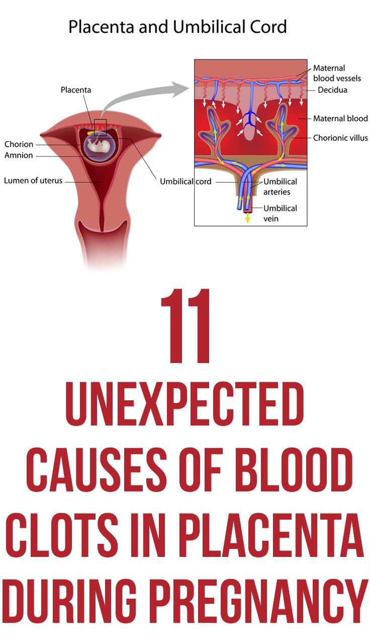 What Causes Big Blood Clots During Pregnancy