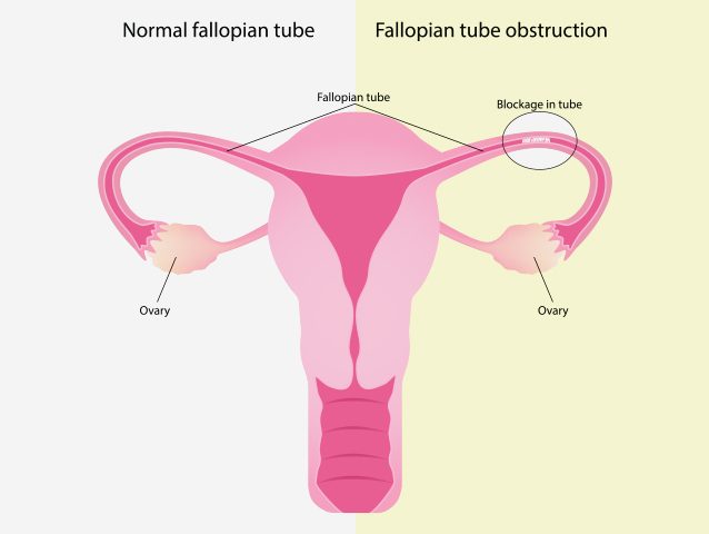 Download Blocked Fallopian Tubes: Causes, Symptoms And Treatment