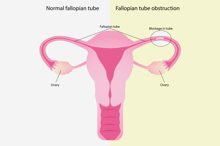 Blocked fallopian tube vis-a-vis a normal fallopian tube