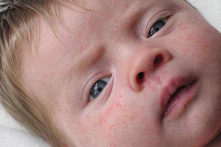 How to treat infant allergic reaction