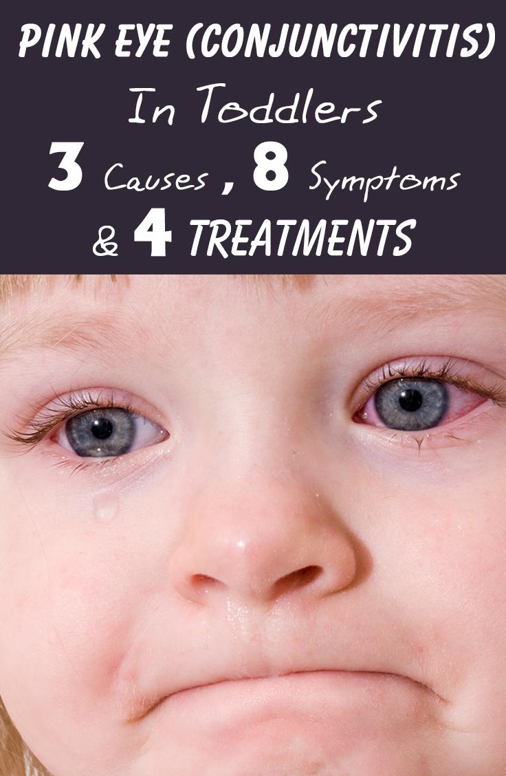 Pink Eye In Toddlers 3 Causes, 8 Symptoms & 4 Treatments You Should