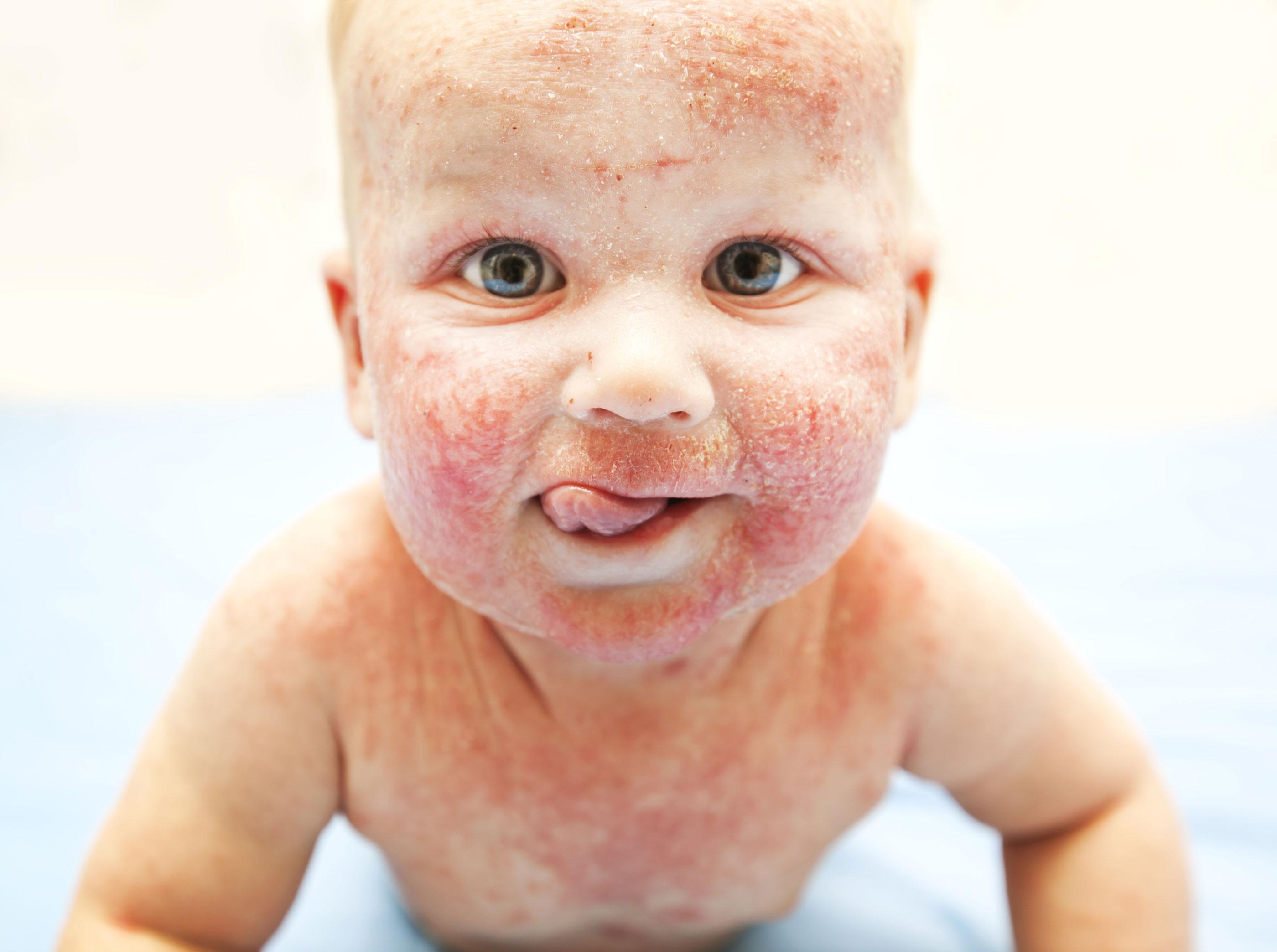 5 Common Types Of Skin Allergies In Babies And Treatment