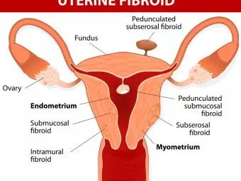 5 Effective Treatments To Cure Uterine Fibroids During Pregnancy