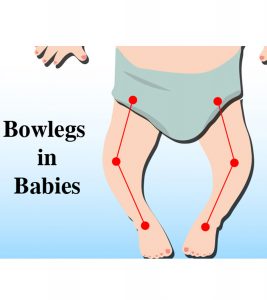 Bowed Legs In Babies: Causes, Symptoms And Treatment