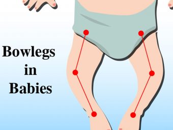 Bowed Legs In Babies: Causes, Symptoms And Treatment