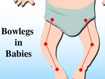 What Are Bowed Legs In Babies? Causes And Treatment