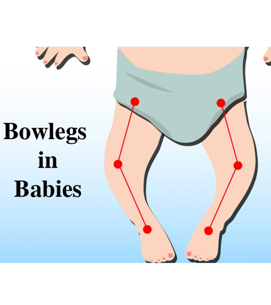 Economisch Dicteren Sta op What Are Bowed Legs In Babies? Causes And Treatment