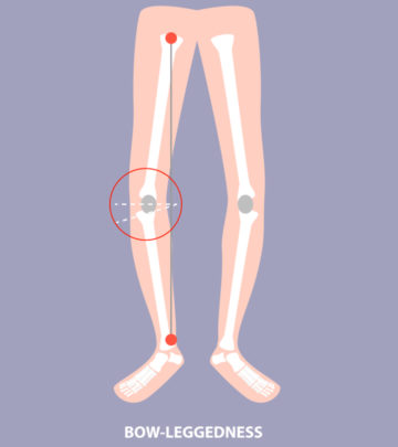 What Are Bowed Legs In Babies? Causes And Treatment_image
