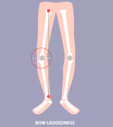 What Are Bowed Legs In Babies? Causes And Treatment_image