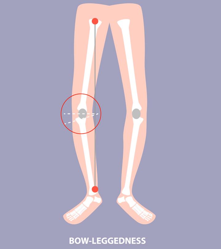 What Are Bowed Legs In Babies? Causes And Treatment MomJunction