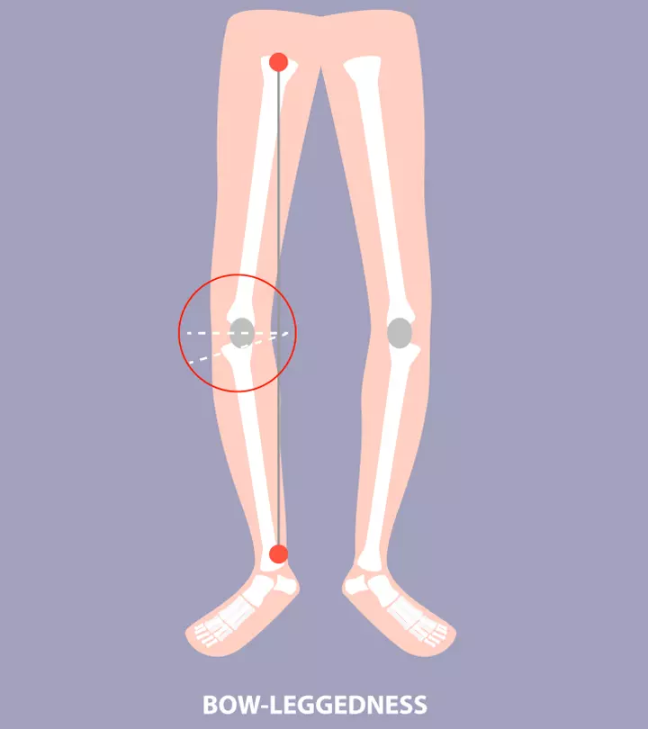 Treatment For Bowed Legs In Babies