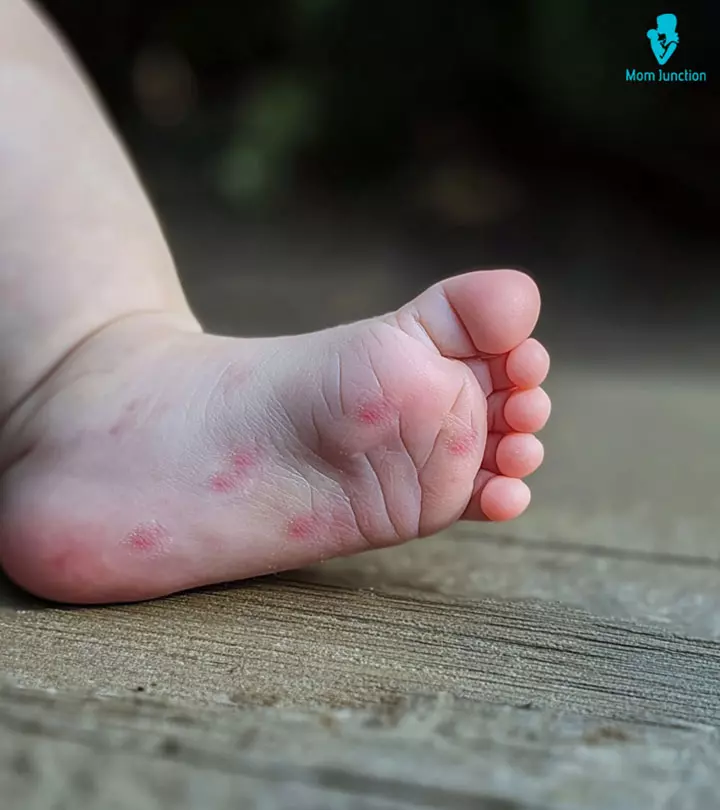 Close-up-Of-A-Baby's-Foot-With-Skin-Disease