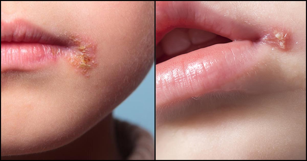 Cold Sores In Babies: Causes, Symptoms And Treatment