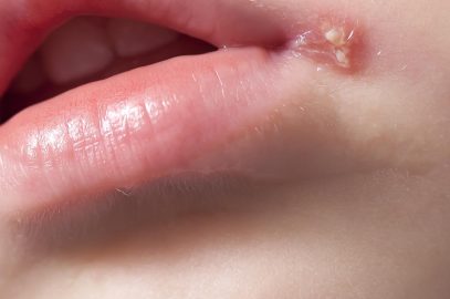 Cold Sores In Babies: Causes, Risk, Treatment & Prevention
