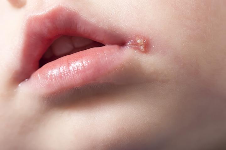 Cold Sores In Babies Causes Symptoms And Treatment